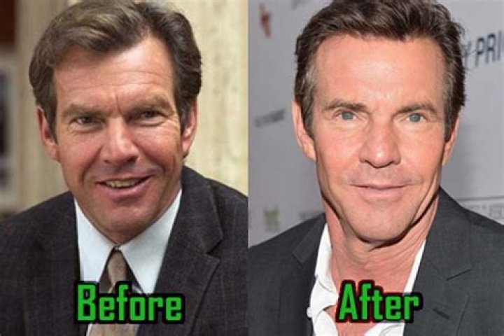 Dennis Quaid Plastic Surgery: Before & After! |